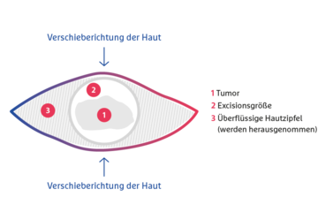 Schematische Darstellung der Dehnungsplastik