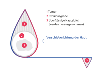 Schematische Darstellung der Nahlappenplastik hier Verschiebelappen (Schnitt gerade)